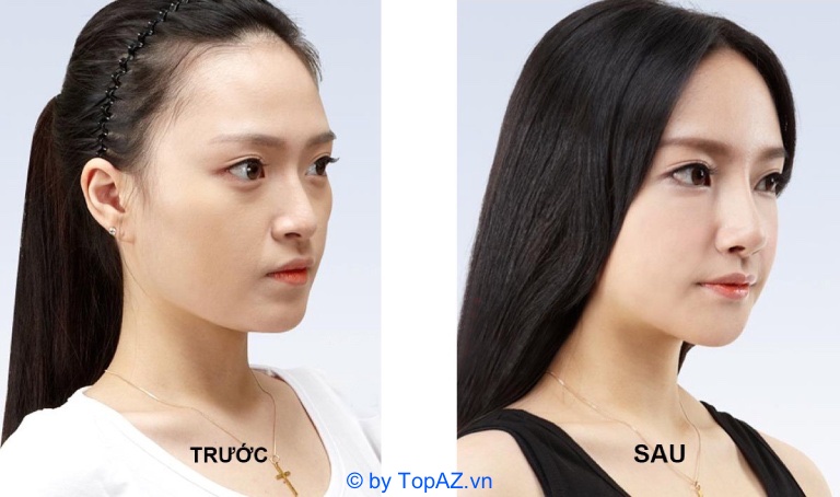 Nâng mũi bọc sụn