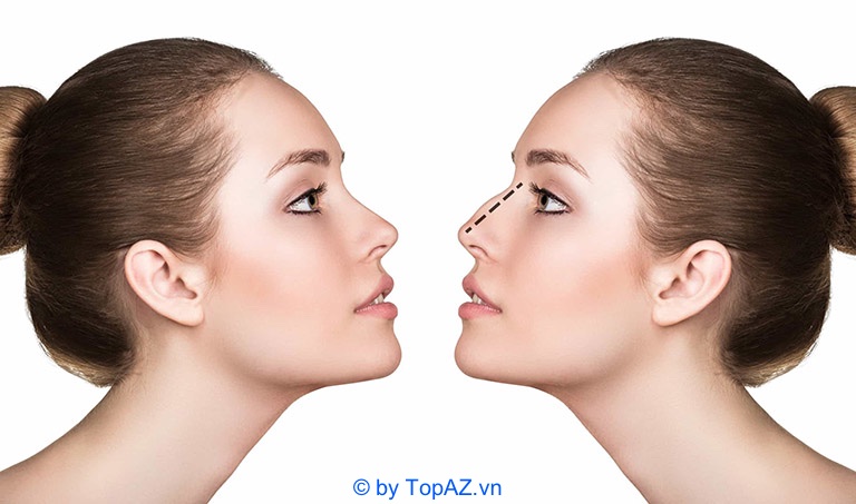 Nâng mũi cấu trúc giá bao nhiêu tiền