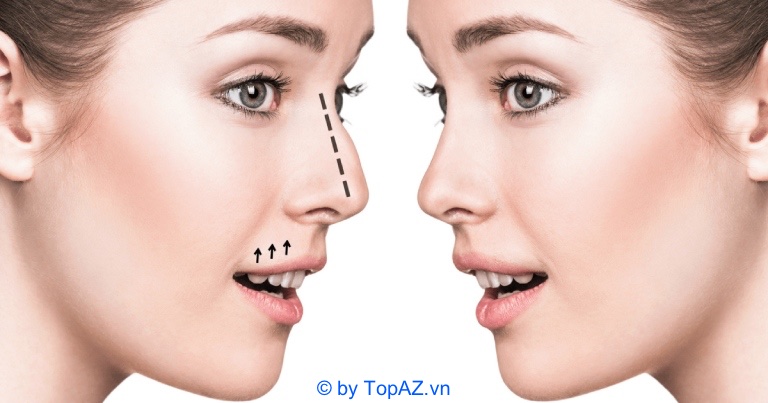 Nâng mũi bằng chỉ collagen là gì?