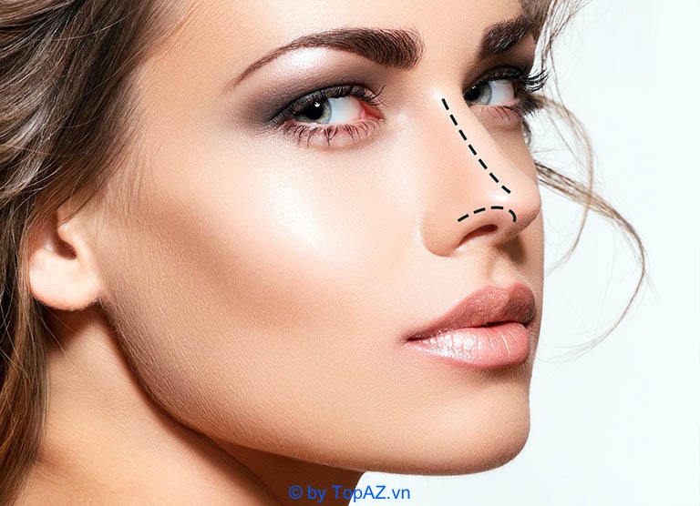 Nâng mũi bằng sụn tự thân là gì?
