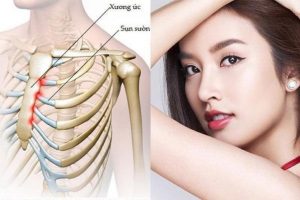 Nâng mũi sụn sườn là gì?