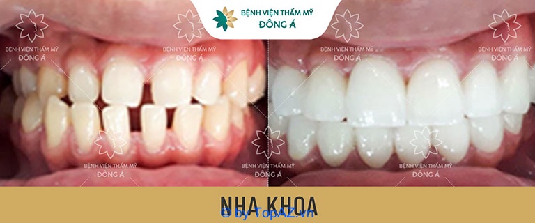 Where should porcelain teeth be covered in Da Nang?
