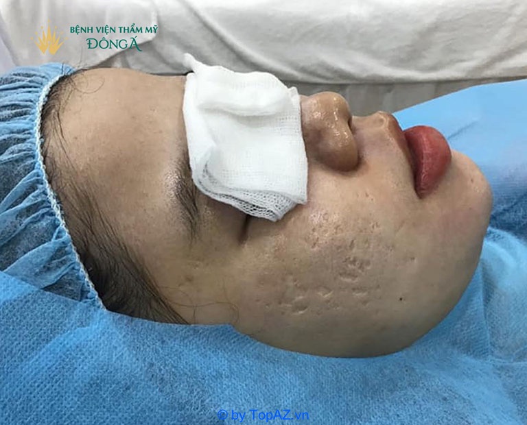 lăn kim trị mụn ở đâu tốt tphcm