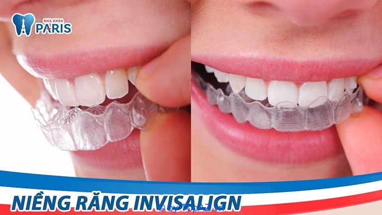 niềng răng trong suốt ở tphcm