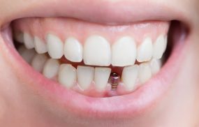 Địa chỉ nha khoa trồng răng implant tphcm uy tín tốt nhất