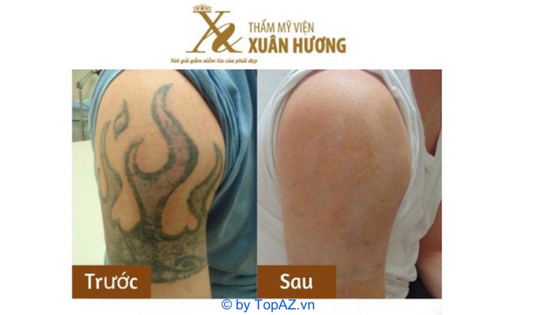 Hình ảnh KH trước và sau khi xóa xăm tại TMV Linh Anh