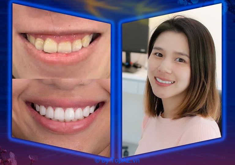 phẫu thuật cười hở lợi ở đâu uy tín tphcm phẫu thuật cười hở lợi ở đâu uy tín tphcm