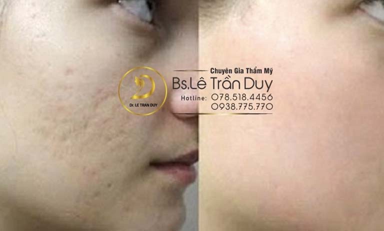 Sẹo lõm trị dứt điểm chỉ sau 1 lần thực hiện tại Dr.Duy