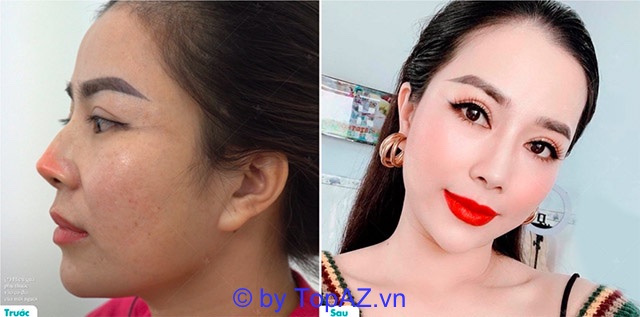 Trước và sau khi sửa mũi hỏng sau khi nâng mũi 