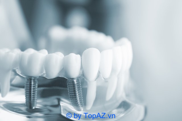 Nha khoa Linh Thiện chuyên về lĩnh vực Implant, răng sứ thẩm mỹ…