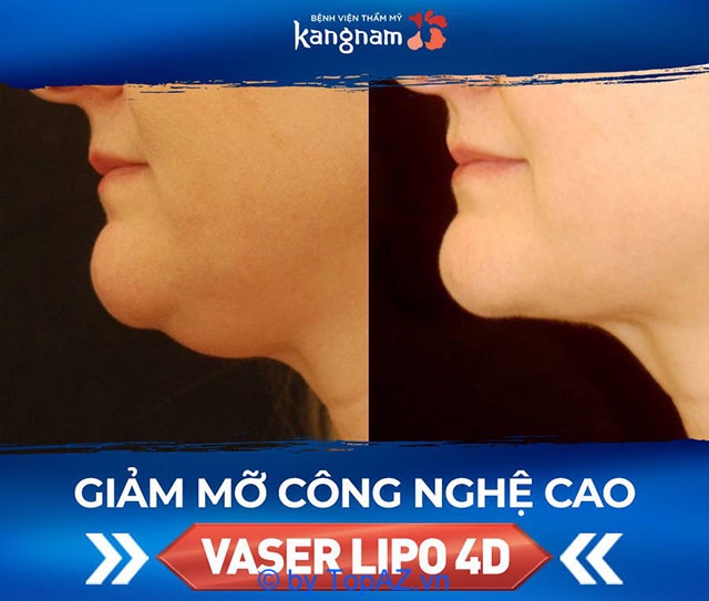 xóa nọng cằm tphcm