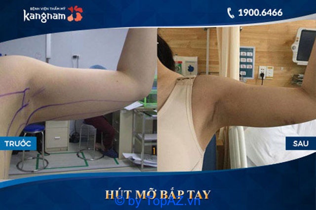 how much does arm liposuction cost tphcm
