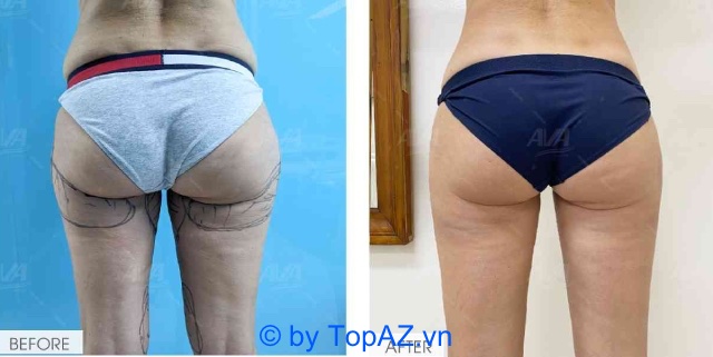 prestigious address of thigh and calf liposuction in Ho Chi Minh City