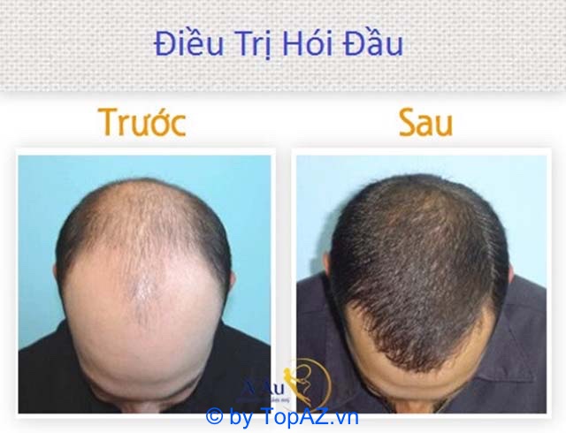 phòng khám trị rụng tóc tphcm
