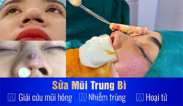 Bác sĩ bùi văn cường sửa mũi hỏng ở Hà Nội