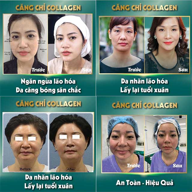 Căng da mặt bằng chỉ Collagen ở tphcm Sài Gòn, anchee Clinic 