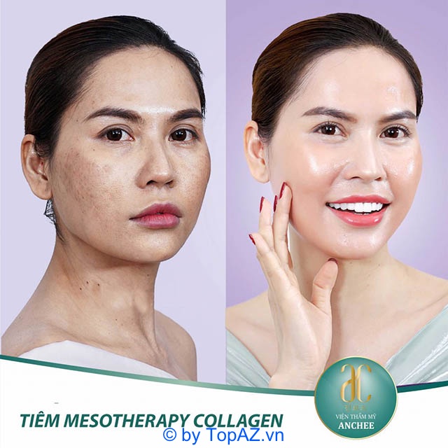 cơ sở tiêm Meso tại TPHCM