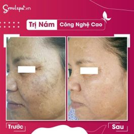Trước và sau khi trị nám tại seoulspa có hiệu quả tốt không