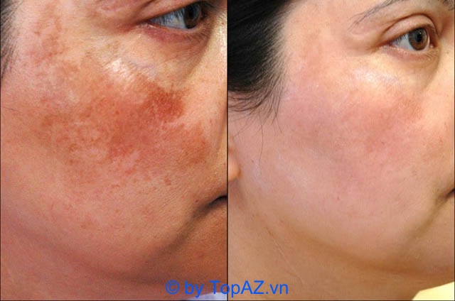 An effective address to treat melasma and freckles in District 1