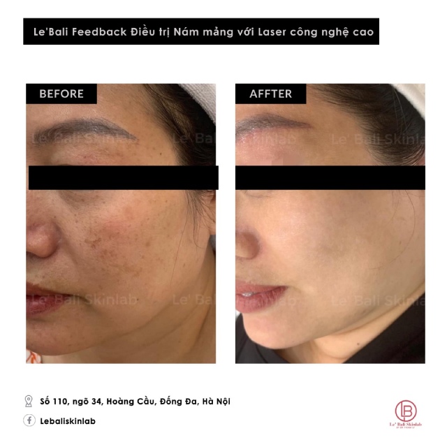 Kết quả trị nám tại Le' Bali SkinLab Hà Nội
