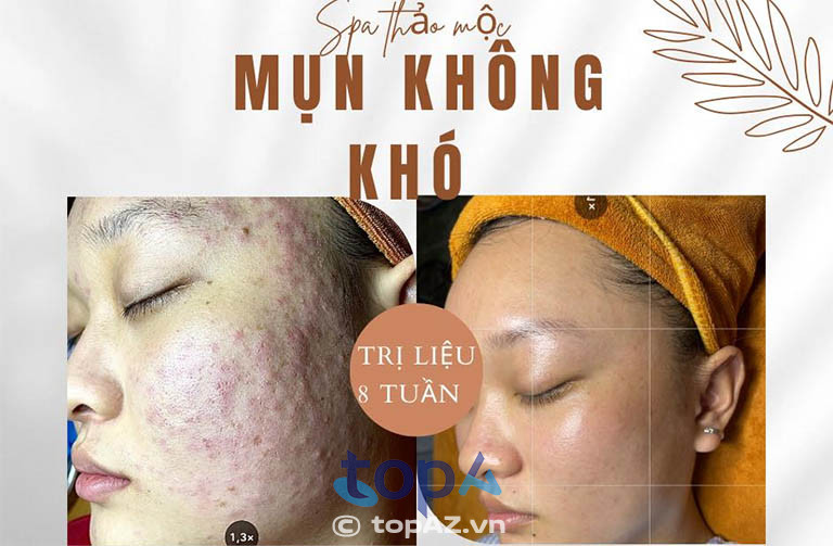 Thảo Mộc Spa trị mụn làm đẹp ở Vị Thanh