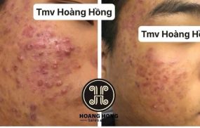 Spa trị mụn, làm đẹp tại TP. Ninh Bình