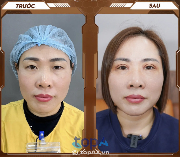 Cắt mí tại Hà Nội Dr Hải Lê