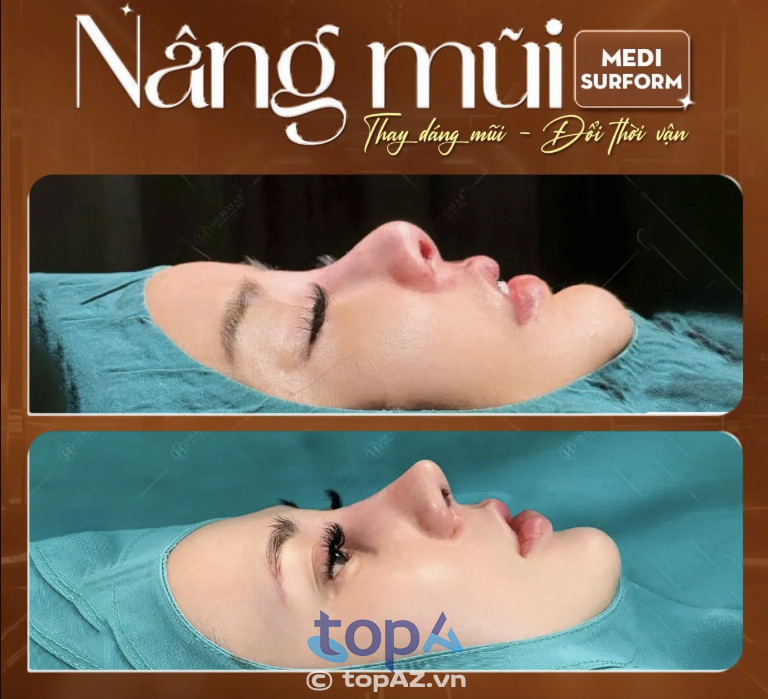 Nâng mũi hà nội dr hải lê