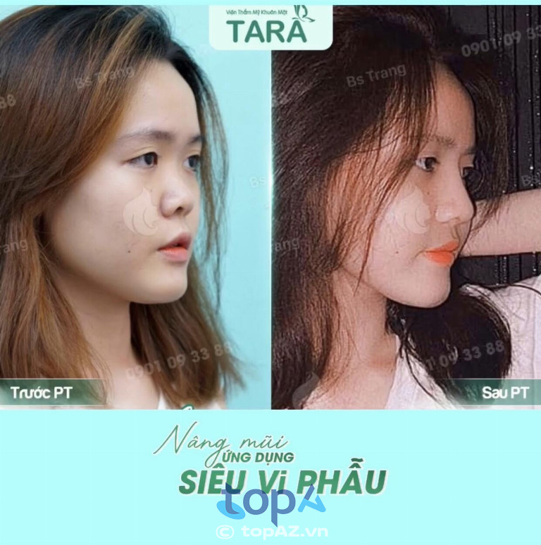 Kết quả nâng mũi ở bác sĩ cái hữu ngọc thảo trang tara