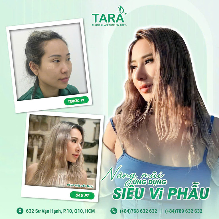 Địa chỉ nâng mũi đẹp TPHCM Tara beauty clinic bác sĩ thảo trang