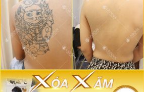 xoá hình xăm tphcm