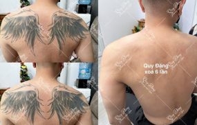 địa chỉ xóa hình xăm tại Hà Nội