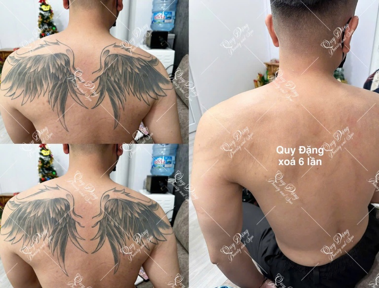 địa chỉ xóa hình xăm tại Hà Nội địa chỉ xóa hình xăm tại Hà Nội
