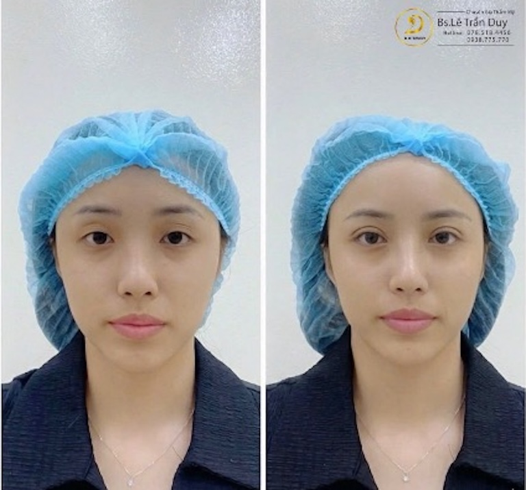 Nhấn mí tphcm bác sĩ lê trần duy