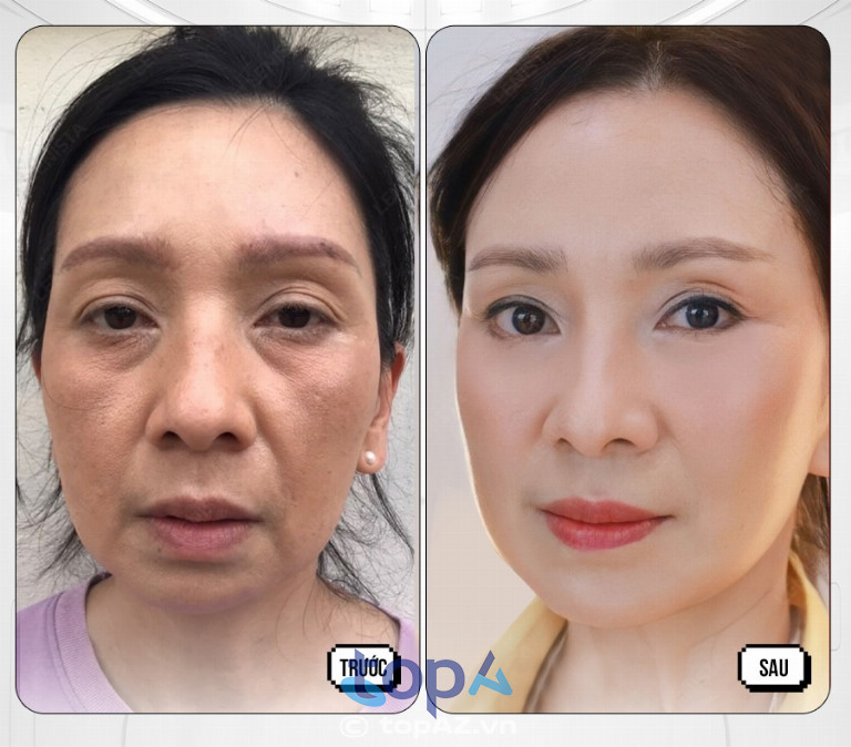 Viện thẩm mỹ Hà Nội được các chuyên gia đánh giá cao và nhiều khách hàng yêu thích để chọn lựa thực hiện dịch vụ căng da mặt