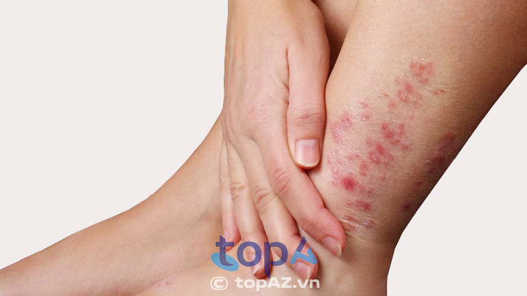Phương pháp điều trị chuẩn y khoa