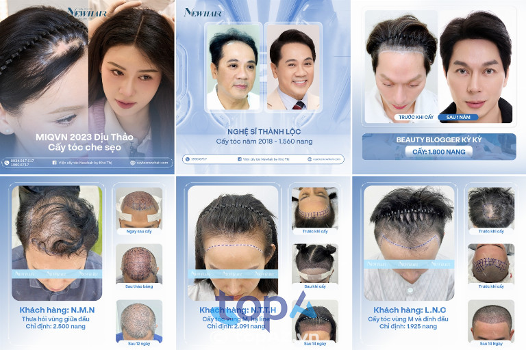 địa chỉ cấy tóc tại TPHCM địa chỉ cấy tóc tại TPHCM