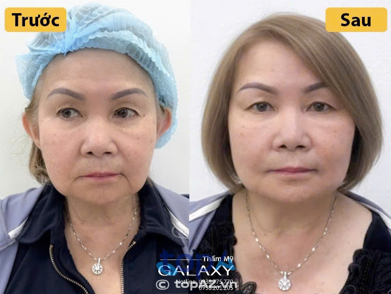Thẩm mỹ viện Galaxy căng da cổ