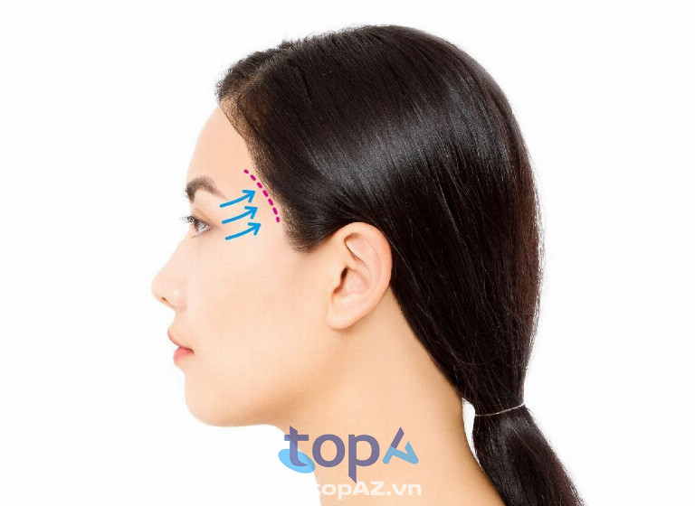 Sử dụng phương pháp căng da phù hợp với từng tình trạng