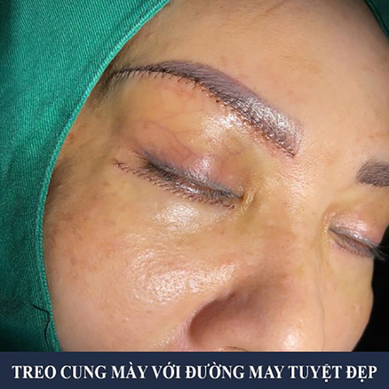 Treo cung chân mày bs le trần duy