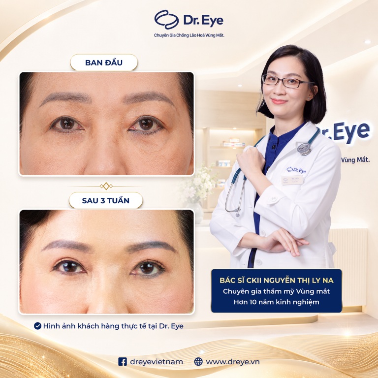BS.CKII Nguyễn Thị Ly Na – Phòng khám Chuyên khoa Thẩm mỹ Dr. Eye tại TPHCM BS.CKII Nguyễn Thị Ly Na – Phòng khám Chuyên khoa Thẩm mỹ Dr. Eye tại TPHCM