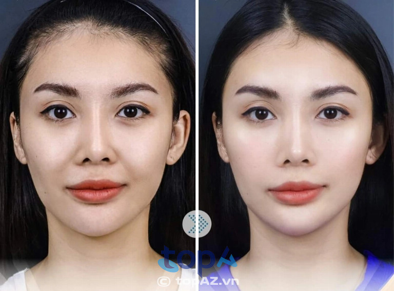 Địa chỉ căng chỉ xóa rãnh cười tại TPHCM