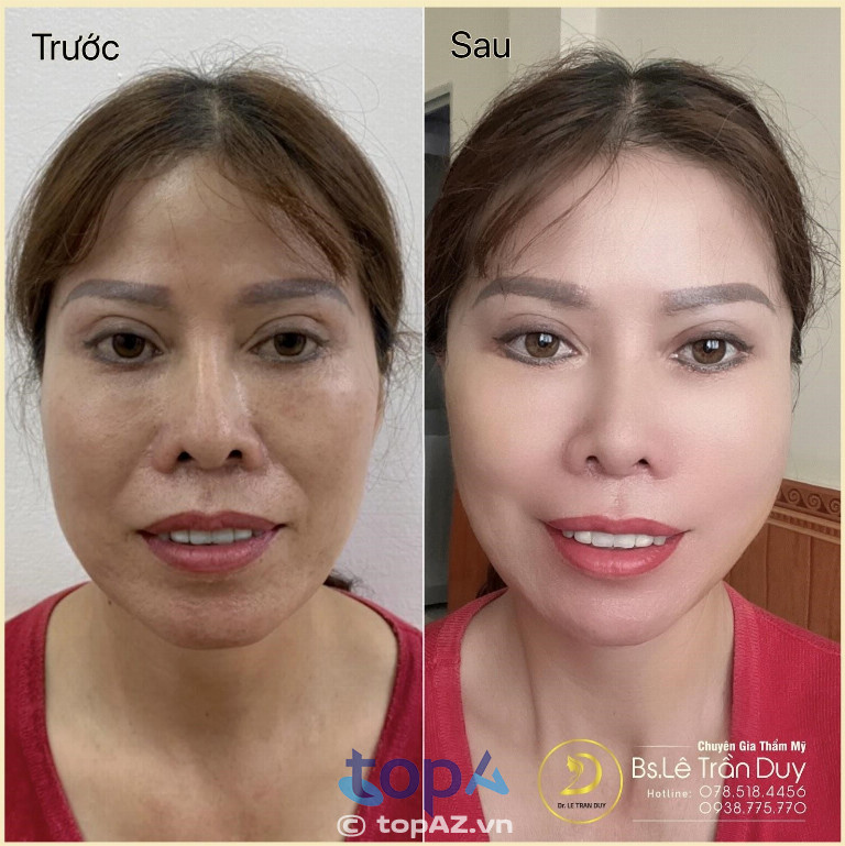 Căng da xóa rãnh cười tại Thẩm mỹ viện Galaxy