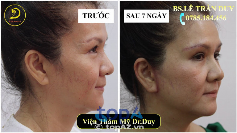 Sau khi căng da bằng chỉ tại Thẩm mỹ viện Galaxy