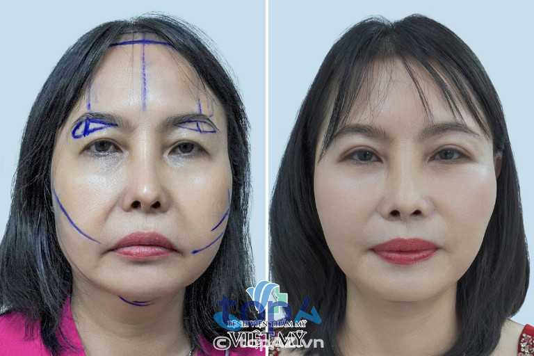 Bệnh viện Thẩm mỹ Việt Mỹ - P. Cầu Ông Lãnh