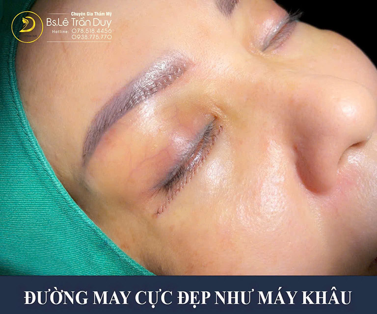 Treo chân mày ở tphcm