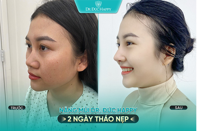Bác sĩ nâng mũi tphcm Ngô Trọng Đức