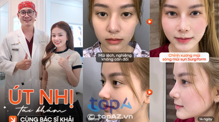Ca sĩ Út Nhị lựa chọn bác sĩ Khải - Bệnh viện Nam An để sửa lại dáng mũi