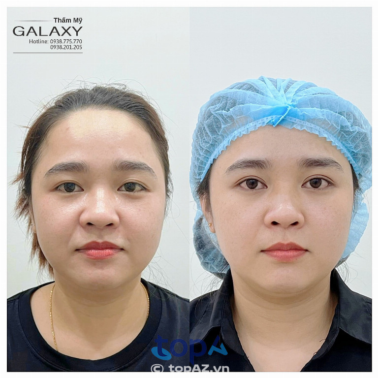 Nhấn mí mắt đẹp tự nhiên tại Thẩm mỹ viện Galaxy