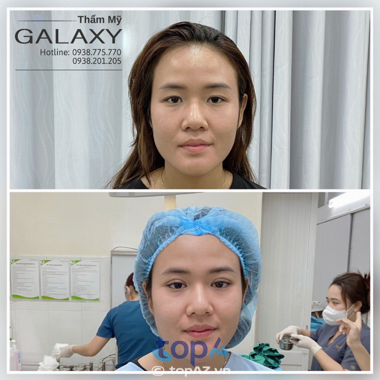 Nhấn mí, cắt mí mắt tại Thẩm mỹ viện Galaxy - BS Lê Trần Duy